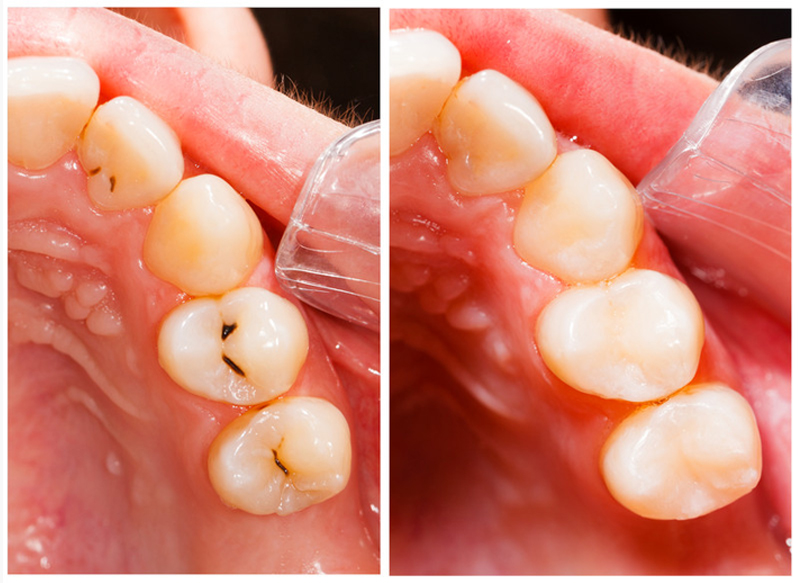 Composite Fillings